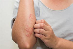 The Difference Between Eczema and Psoriasis - D'Scent Essentials
